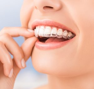 Invisalign new hyde park dental