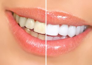 Teeth whitening in Lynbrook, NY at South Shore Dental