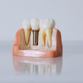 dental implant