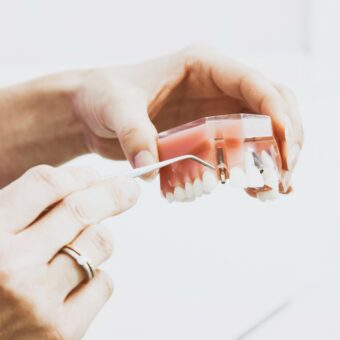 dental bridges vs dental implants